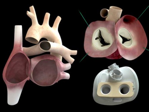 Jantung Buatan Carmat dengan Bentuk dan Fungsi Layaknya Jantung Asli 2 artificial-heart