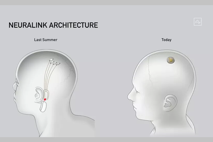 Neuralink Chip Otak Manusia