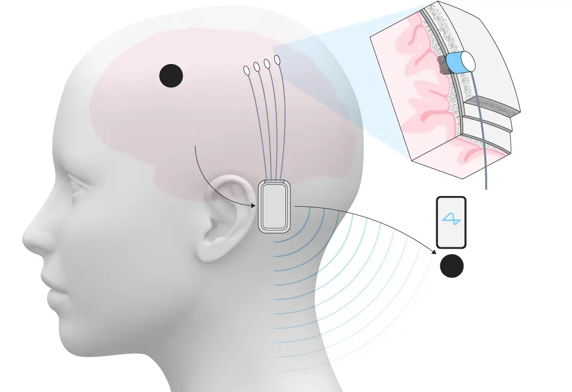 Neuralink Mulai Uji Coba Chip Otak di Inggris